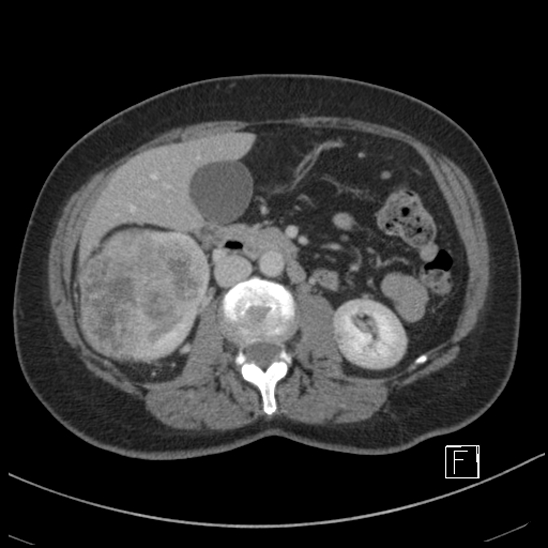 Breast metastases from renal cell cancer (Radiopaedia 79220-92225 C 44).jpg