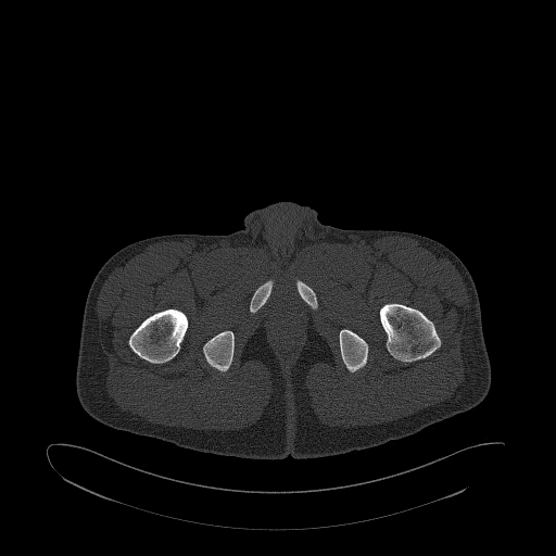 Brodie abscess- femoral neck (Radiopaedia 53862-59966 Axial bone window 201).jpg