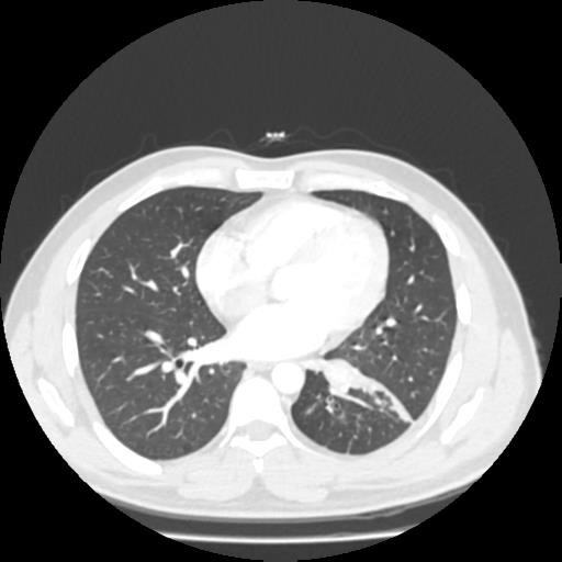 Bronchial carcinoid (Radiopaedia 80013-93291 Axial lung window 74).jpg