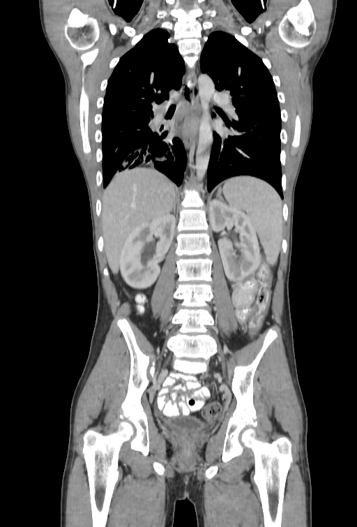 Bronchial carcinoid tumor (Radiopaedia 57187-64090 B 73).jpg