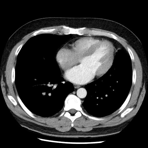 Bronchial carcinoid tumor (Radiopaedia 67377-76764 A 40).jpg