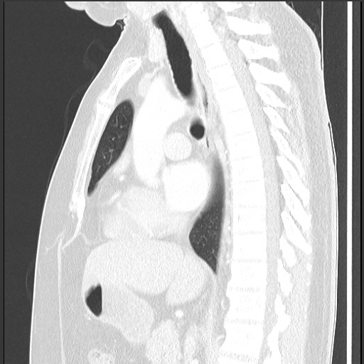 Bronchial carcinoid tumor (Radiopaedia 67377-76764 Sagittal lung window 35).jpg