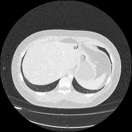 Bronchial carcinoid tumor (Radiopaedia 78272-90875 Axial lung window 48).jpg