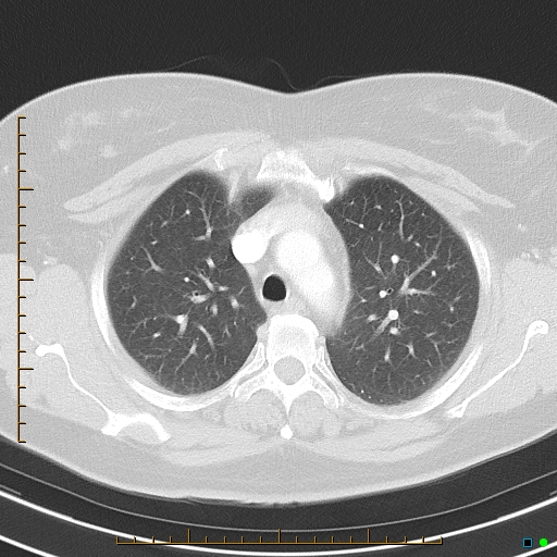 Bronchial diverticula (Radiopaedia 79512-92675 Axial lung window 14).jpg