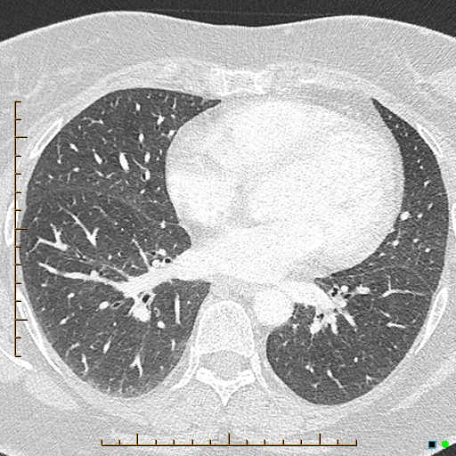 Bronchial diverticula (Radiopaedia 79512-92676 Axial lung window 121).jpg