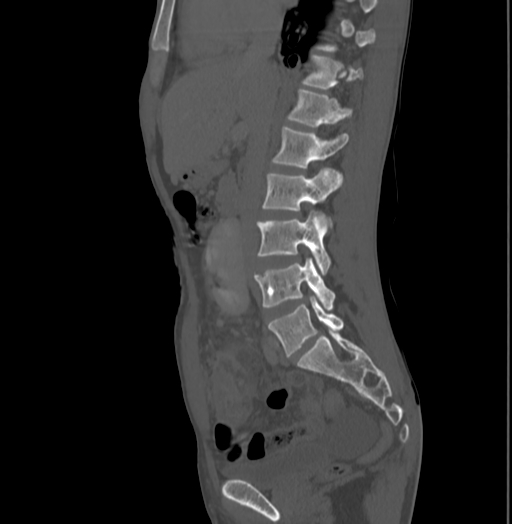Bronchiectasis in Crohn disease (Radiopaedia 60311-67977 Sagittal bone window 104).jpg