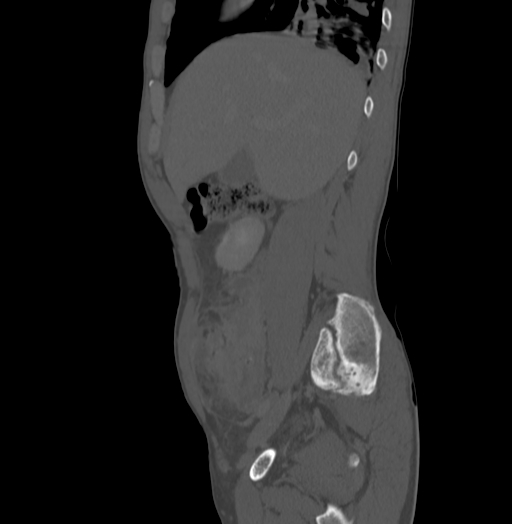 Bronchiectasis in Crohn disease (Radiopaedia 60311-67977 Sagittal bone window 61).jpg