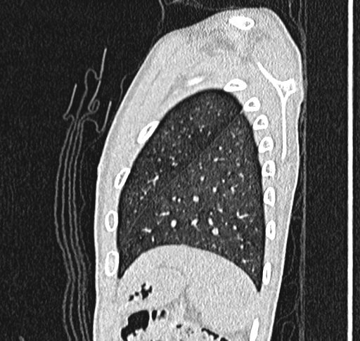 Bronchiolitis obliterans (Radiopaedia 71538-81897 Sagittal lung window 61).jpg