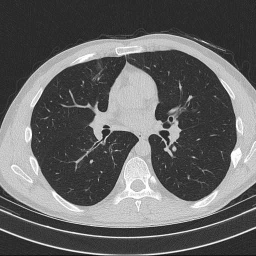 Bronchocele (Radiopaedia 60676-68429 Axial lung window 36).jpg