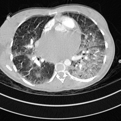 Bronchogenic cyst (Radiopaedia 77801-90071 Axial lung window 43).jpg