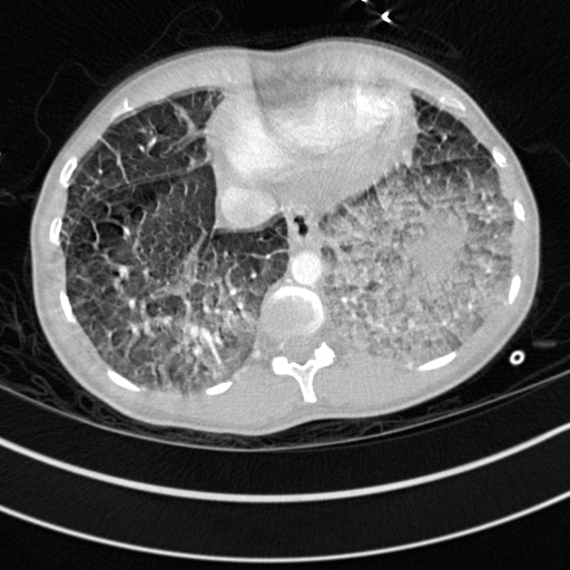 Bronchogenic cyst (Radiopaedia 77801-90071 Axial lung window 71).jpg