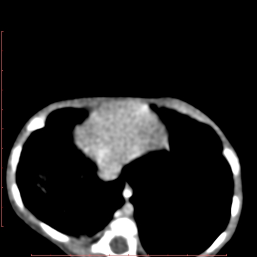 Bronchogenic cyst (Radiopaedia 78599-91409 B 158).jpg