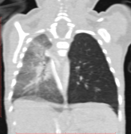Bronchogenic cyst (Radiopaedia 78599-91409 Coronal lung window 152).jpg