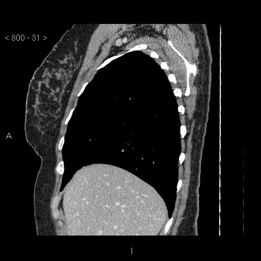 Bronchogenic cyst - posterior mediastinal (Radiopaedia 43885-47364 B 20).jpg