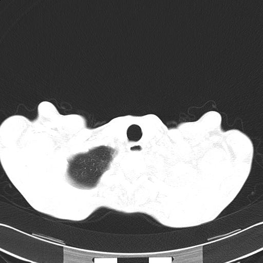 Bronchopleural fistula secondary to tuberculosis (Radiopaedia 20415-20322 Axial lung window 7).jpg