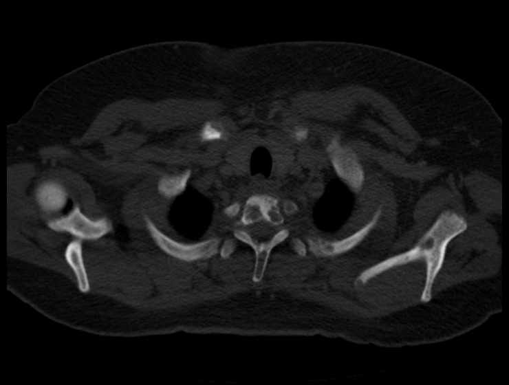 Brown tumors compressing the spinal cord (Radiopaedia 68442-77988 Axial bone window 8).jpg