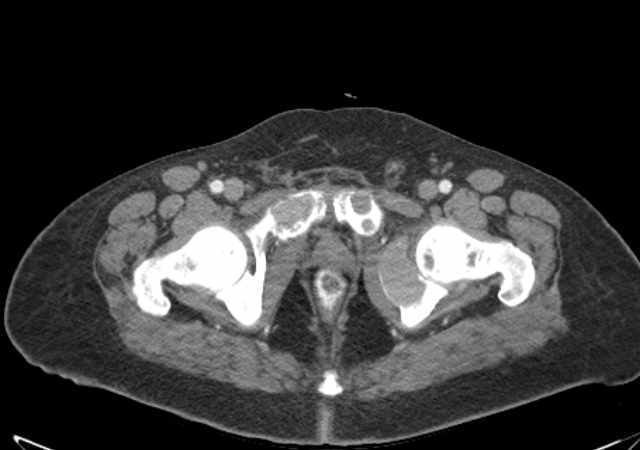 Brown tumors compressing the spinal cord (Radiopaedia 68442-77988 E 124).jpg