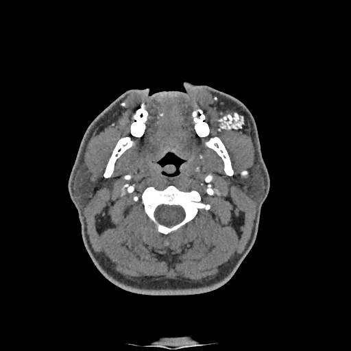 Buccal fat pad arteriovenous malformation (Radiopaedia 70936-81144 D 187).jpg