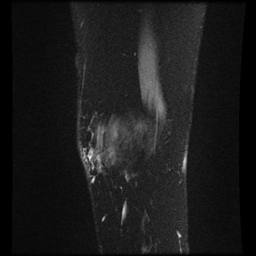 Bucket handle meniscus tear (Radiopaedia 56916-63751 H 82).jpg