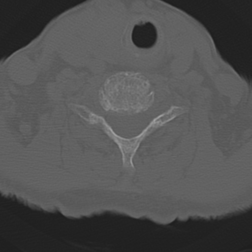 File:C2 fracture with vertebral artery dissection (Radiopaedia 37378-39199 Axial bone window 38).png