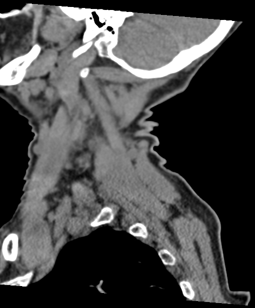 C2 fracture with vertebral artery dissection (Radiopaedia 37378-39199 D 67).png