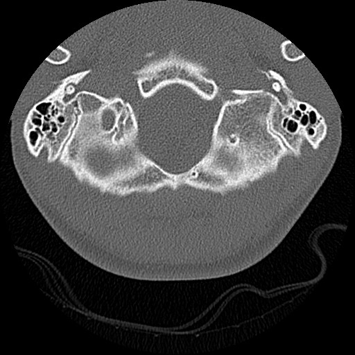 File:C5 facet fracture (Radiopaedia 58374-65499 Axial bone window 5).jpg