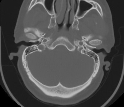 C7 laminar fracture and Klippel-Feil syndrome (Radiopaedia 86710-102850 Axial bone window 14).jpg