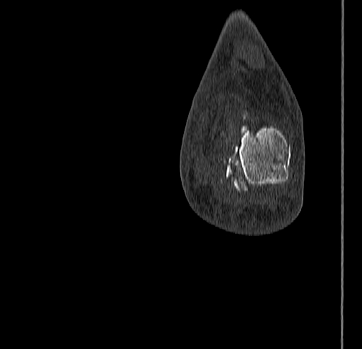 Calcaneal fracture - Sanders type 4 (Radiopaedia 90179-107370 Coronal bone window 81).jpg