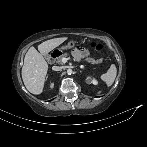 Calcified adrenal glands and Spigelian hernia (Radiopaedia 49741-54988 A 67).jpg