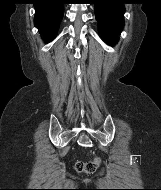 Calcified adrenal glands and Spigelian hernia (Radiopaedia 49741-54988 B 103).jpg
