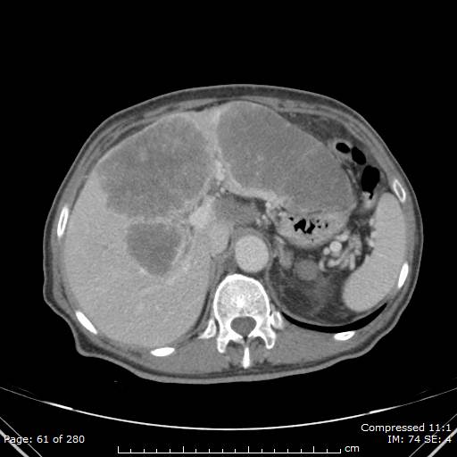 Calcified liver metastases (Radiopaedia 44699-48470 B 22).jpg