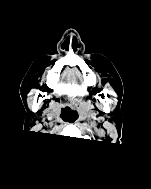 Calcified meningioma (Radiopaedia 74361-85243 Axial non-contrast 65).jpg