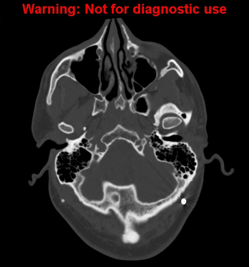 Calvarial thickening from chronic shunting (Radiopaedia 60079-67637 Axial bone window 25).jpg