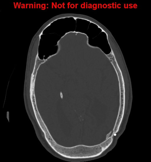 File:Calvarial thickening from chronic shunting (Radiopaedia 60079-67637 Axial bone window 87).jpg