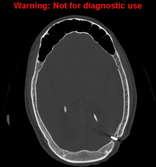 Calvarial thickening from chronic shunting (Radiopaedia 60079-67637 Axial bone window 95).jpg
