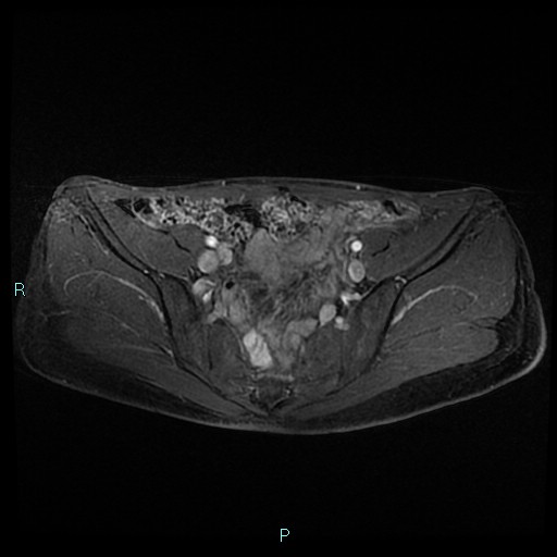 File:Canal of Nuck cyst (Radiopaedia 55074-61448 Axial T1 C+ fat sat 18).jpg