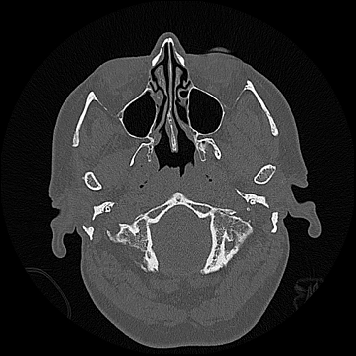 Canal up mastoidectomy (Radiopaedia 78108-90638 Axial bone window 18).jpg