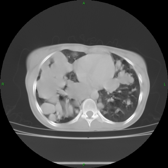 File:Cannon ball metastases - synovial sarcoma (Radiopaedia 26135-26271 Axial lung window 24).jpg