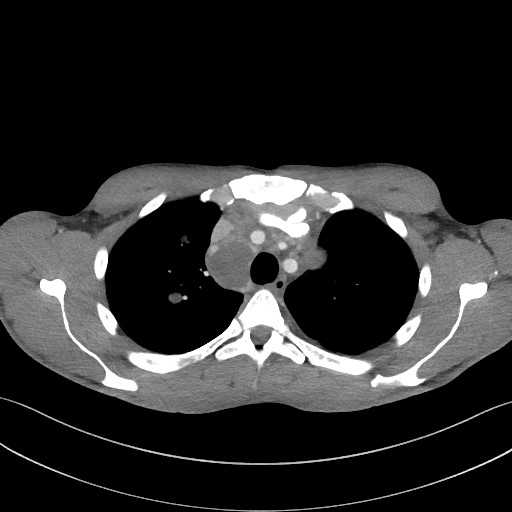 Cannonball metastases - testicular choriocarcinoma (Radiopaedia 84510-99891 B 35).jpg