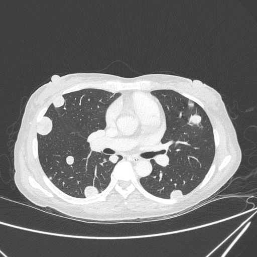 Canonball lung metastasis (Radiopaedia 77634-89837 Axial lung window 84).jpg