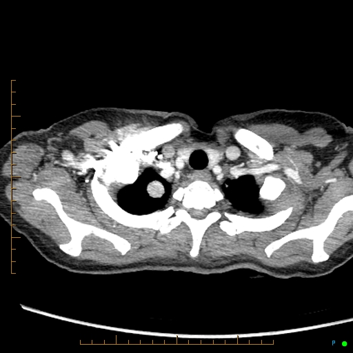 Canonball lung metastasis (Radiopaedia 77634-89837 B 5).jpg