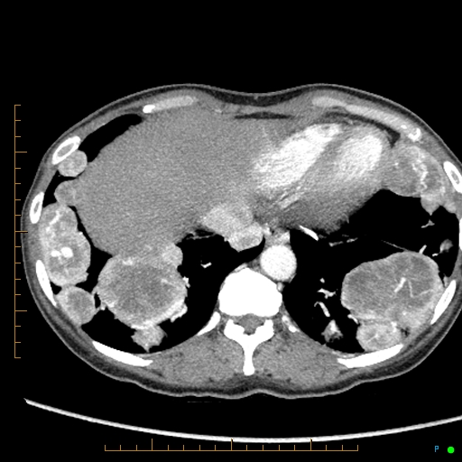 Canonball lung metastasis (Radiopaedia 77634-89837 B 82).jpg