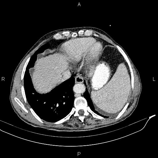 File:Caput medusae sign - portal hypertension (Radiopaedia 64007-72759 A 5).jpg