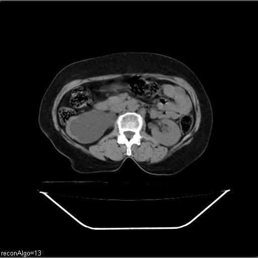 File:Carcinoma cervix- recurrence (Radiopaedia 34702-36137 Axial non-contrast 22).jpg