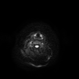 Carcinoma ex-pleomorphic adenoma of parotid (Radiopaedia 28383-28627 Ax DWI B-500 GE 38).jpg