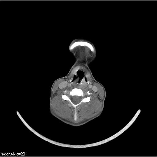 Carcinoma of the maxillary antrum (Radiopaedia 53805-59888 Axial C+ delayed 20).jpg