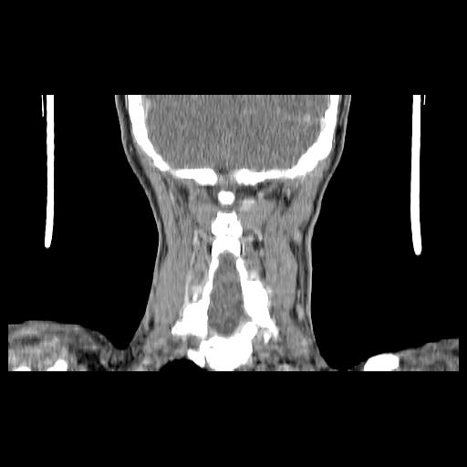 Carcinoma of the maxillary antrum (Radiopaedia 53805-59888 Coronal C+ delayed 133).jpg