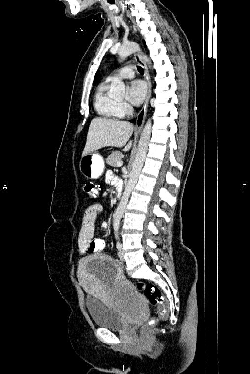 Carcinoma of uterine cervix (Radiopaedia 85861-101700 D 44).jpg