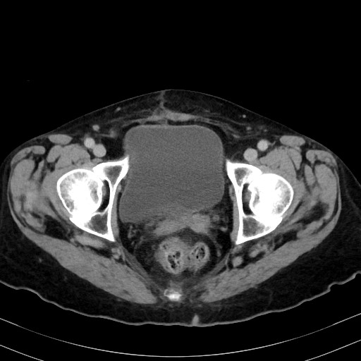 Carcinosarcoma (Radiopaedia 70401-80503 A 63).jpg