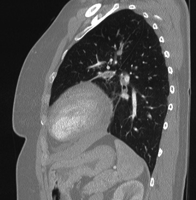 File:Cardiac sarcoidosis (Radiopaedia 74548-85534 Sagittal lung window 27).jpg